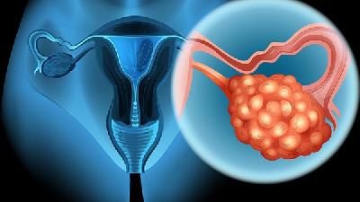 卵巢癌医院检查指标