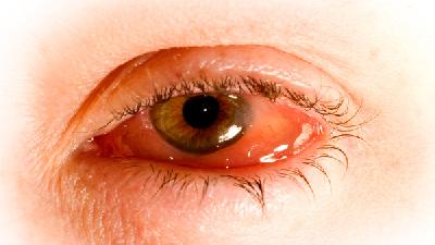 红眼病的预防和护理