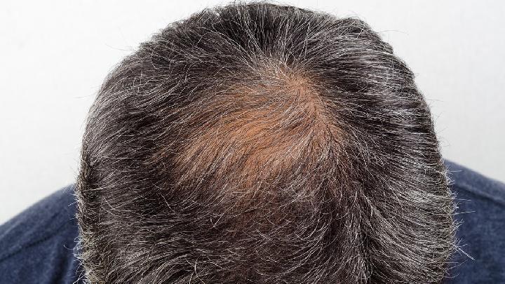 专家谈男性脱发的防治