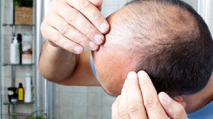 男性脱发的三大症状表现