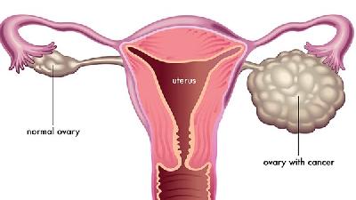 女性患上子宫内膜异位症如何护理