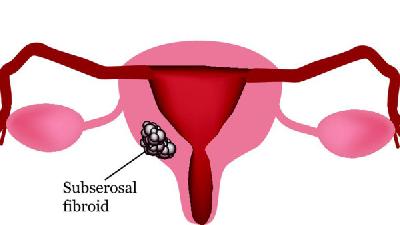 女性子宫腺肌症有哪些危害