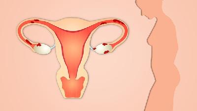 卵巢畸胎瘤的护理措施