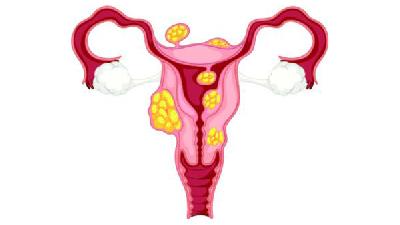中医解释子宫内膜息肉是什么
