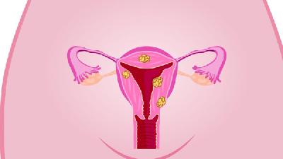 预防卵巢肿瘤的常见方法有哪些
