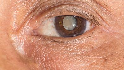 白内障对眼睛有哪些危害