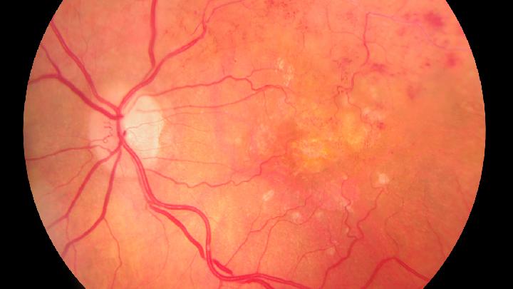 视网膜脱落患者正确运动方法是什么