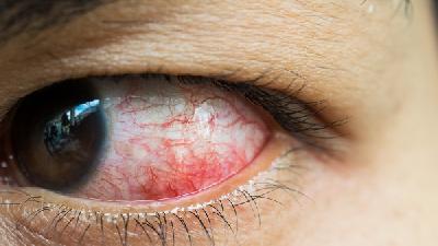 中医药能有效防治眼结石吗