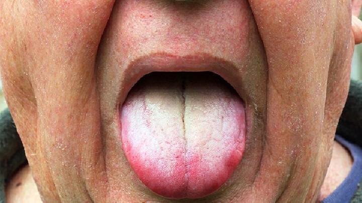 舌癌主要护理问题有哪些