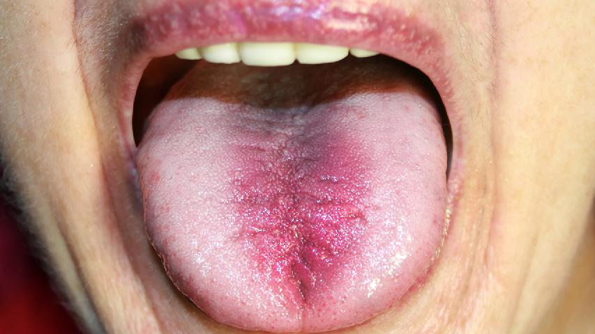 女性更要警惕舌癌伤害