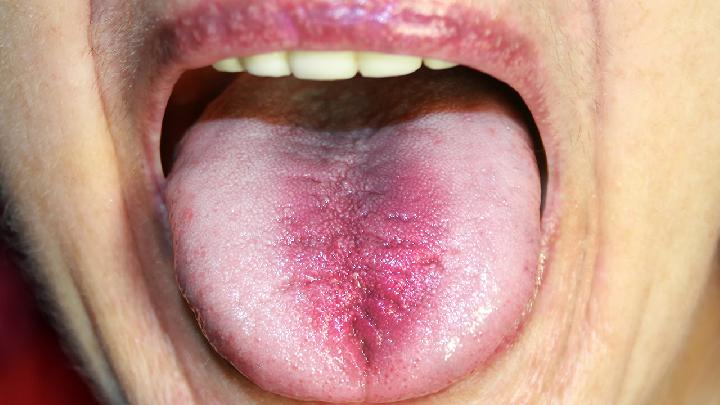 舌癌中期症状是什么