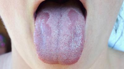 地图舌的常见症状有哪些