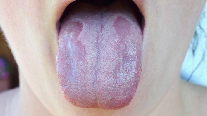 地图舌疾病会遗传吗