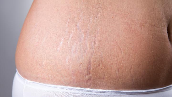 妊娠纹对患者的几种危害