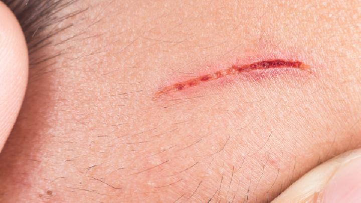 受伤后应该怎么处理才能避免疤痕产生