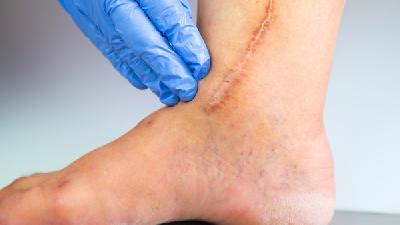 如何选择适合自己的祛疤手术