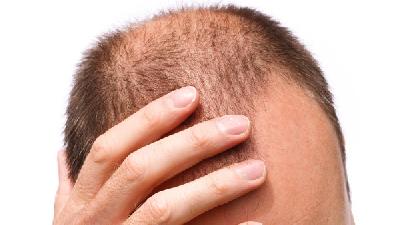 秃顶自我诊断的标准是什么