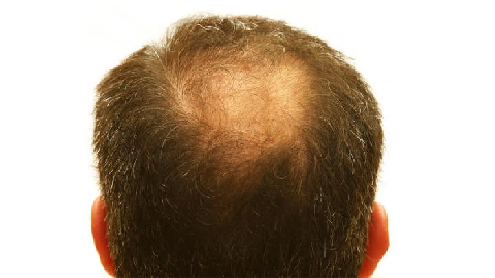 生活中如何预防秃顶的发生