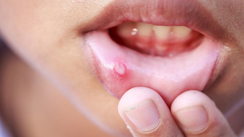 口唇疱疹的食疗方案