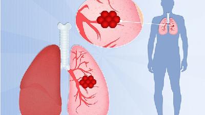 小细胞肺癌的人寿命一般是多久
