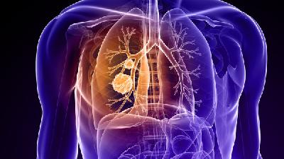小细胞肺癌患者应养成的护理好习惯