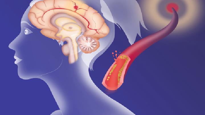 专家解析脑血管痉挛的四大原因