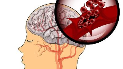 男性脑血管痉挛患者的症状表现是什么