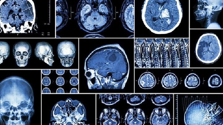 脑出血的检查方法哪些较好