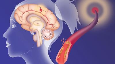 什么原因會(huì)誘發(fā)腦積水
