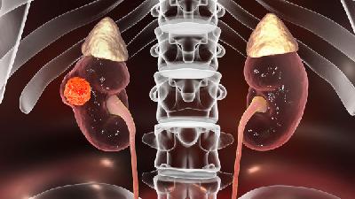 如何避免腎上腺腫瘤的復(fù)發(fā)