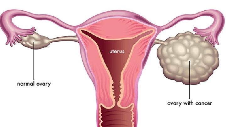 卵巢功能异常综合征