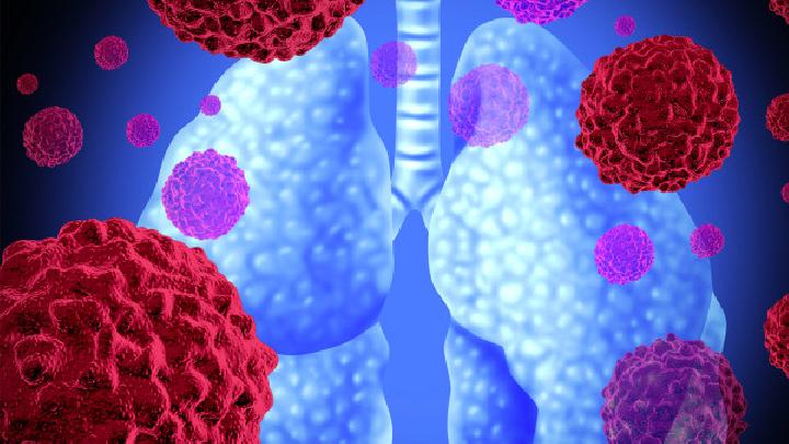 肺癌早期除了咳嗽还有哪些特征这三点要多注意