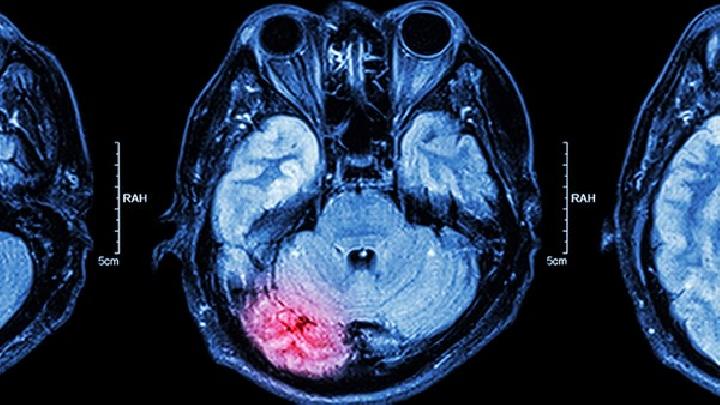 脑溢血有哪些后遗症？