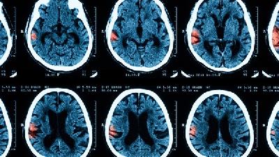 新生兒偏癱型腦癱中醫(yī)治療