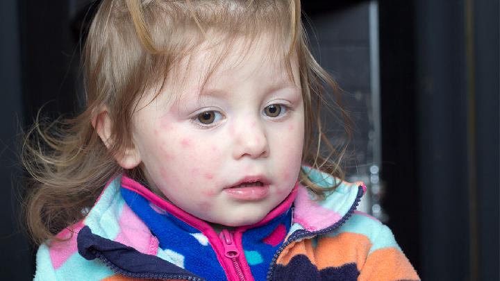 导致小儿荨麻疹的过敏原是什么