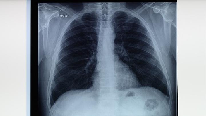 肺癌被诱发的因素有哪些?
