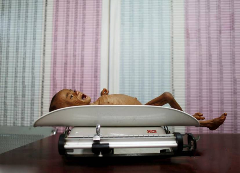 也门儿童患营养不良瘦成"皮包骨 触目惊心