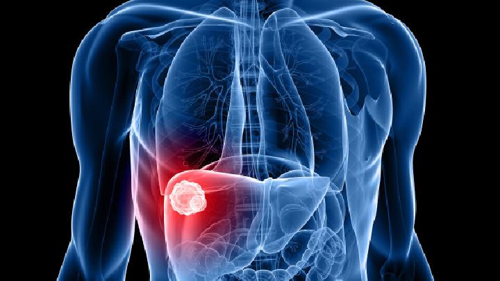哪些肝部疾病易误诊为肝癌