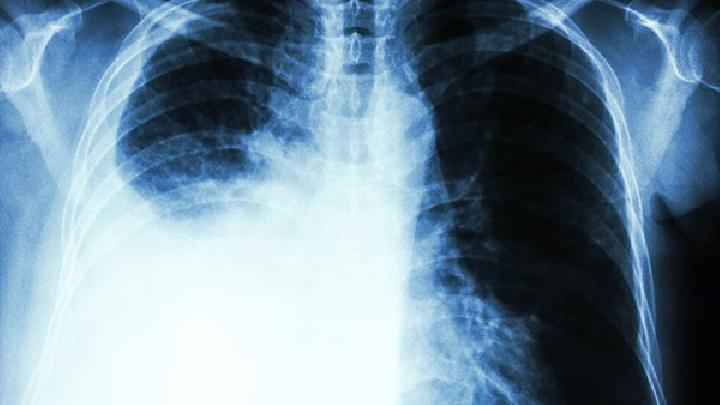 如何预防肺纤维化