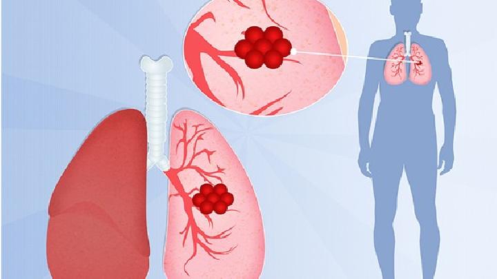 了解肺气肿的分类是怎样的