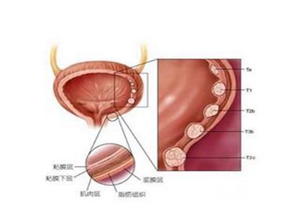 膀胱癌能活多久图片