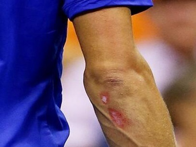 骨癌的晚期治愈率_骨癌的治愈率是多少_骨癌