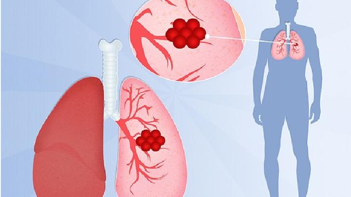 矽肺患者的病理变化是什么呢