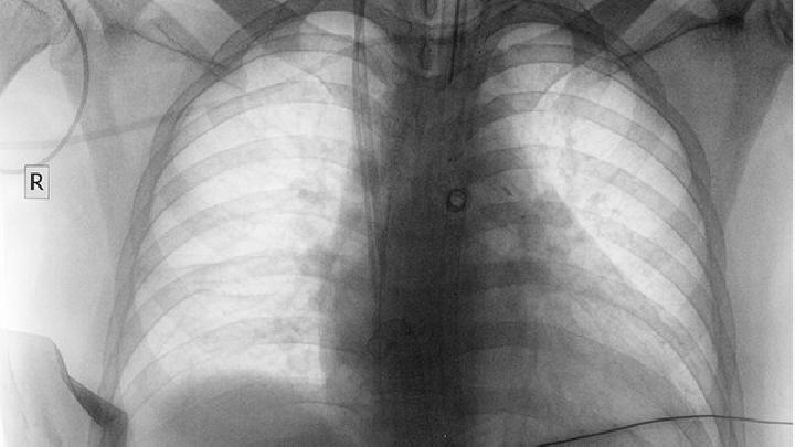 矽肺容易与哪些疾病混淆？