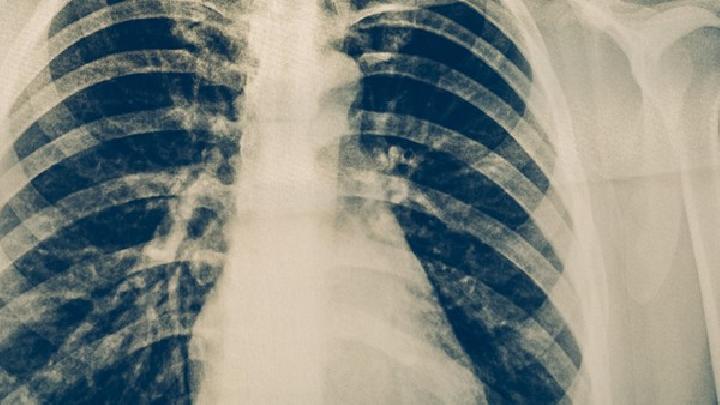 滑石粉尘肺有哪些表现及如何诊断？