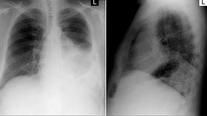 肺弓形体病是由什么原因引起的？