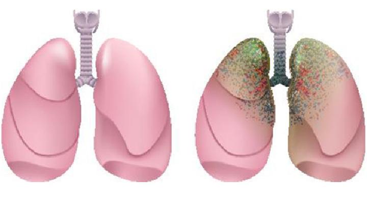 一般情况下矽肺一经发现就为晚期