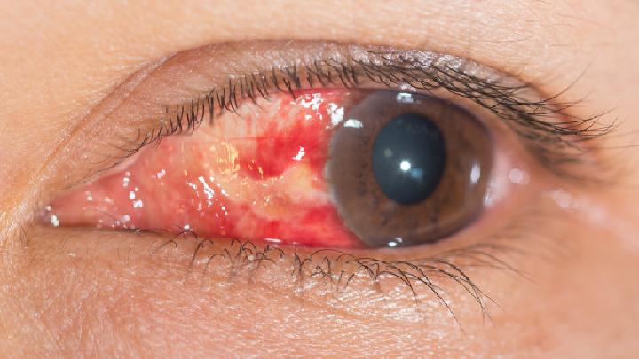 眼假组织胞质菌病综合征有哪些症状