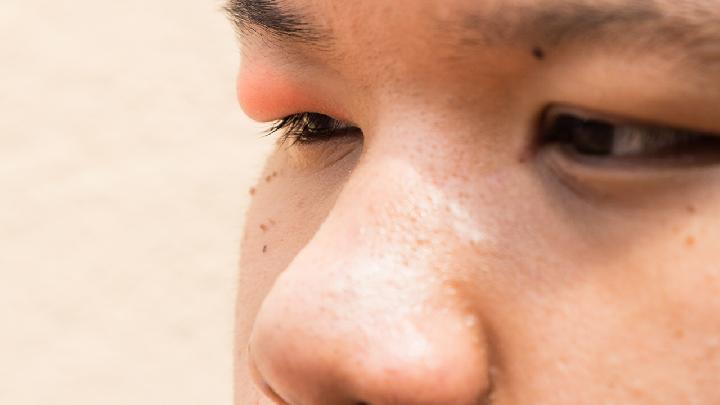 眼烧伤应该如何预防？