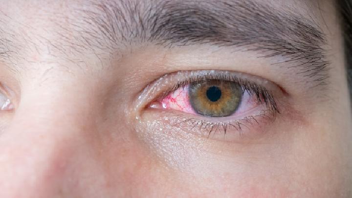 红眼病的诊断依据